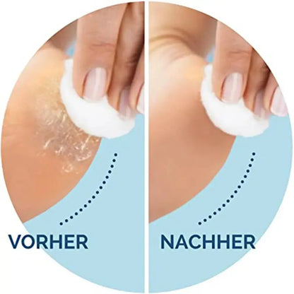 CorrectorFoot Care Tool Replacement Rollers - Nisiowelt